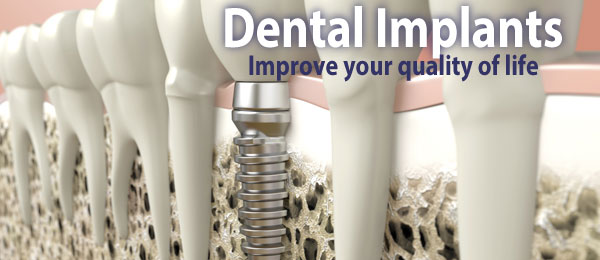Dental Implants improve your quality of life