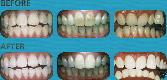Poladay before and after whitening